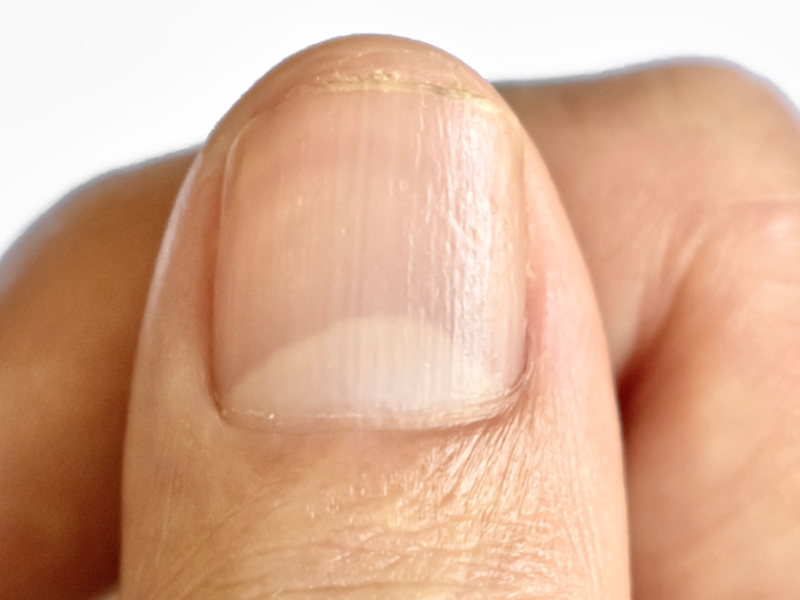 Ein Fingernagel, bei dem die Lunula gut ausgeprägt ist. Der weiße Halbmond gibt Ausschluss über die Gesundheit.