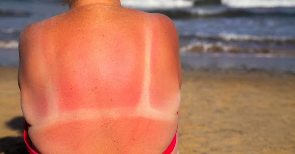 Eine Frau mit Sonnenbrand auf dem Rücken