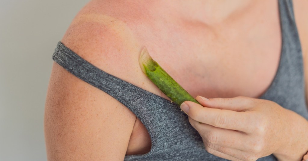 Frau reibt Sonnenbrand mit Aloe vera Pflanze ein 